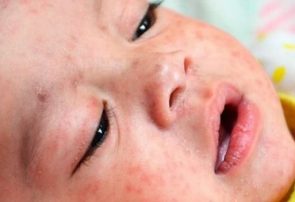 علائم “سرخک” و اهمیت واکسیناسیون کودکان در موعد مقرر